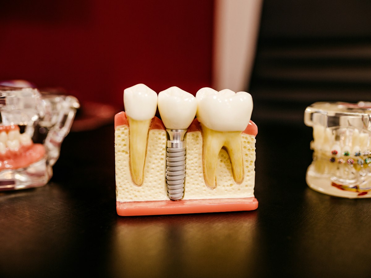 Model of a dental implant beside natural teeth