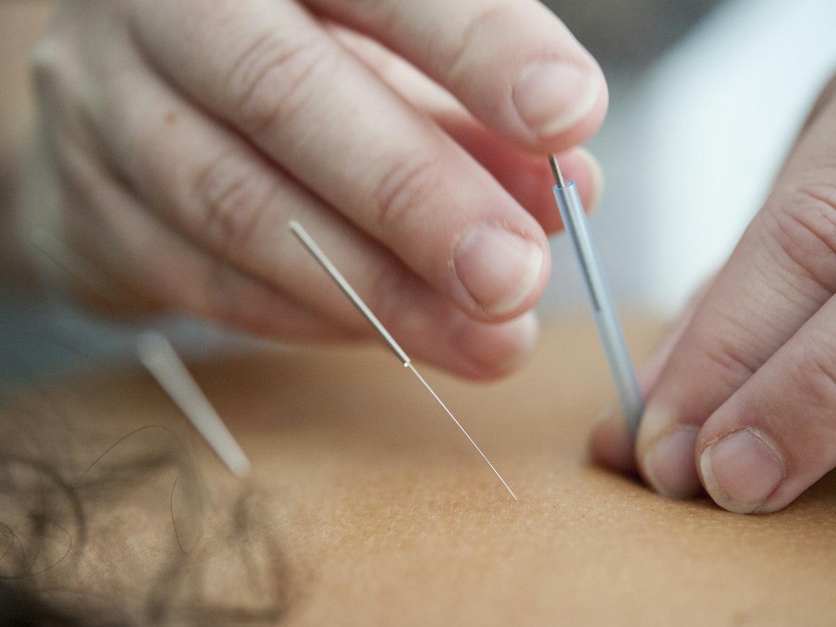 Close-up of a practitioner placing a fine acupuncture needle into the skin through a thin guide tube